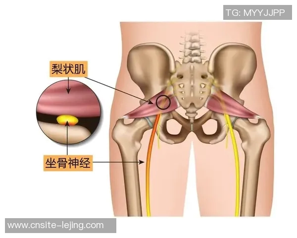 专家解读坐骨神经痛成因及治疗方法大多数患者可避免手术治疗
